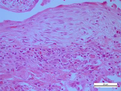 Fibroblasts From Idiopathic Pulmonary Fibrosis Induce Apoptosis and Reduce the Migration Capacity of T Lymphocytes